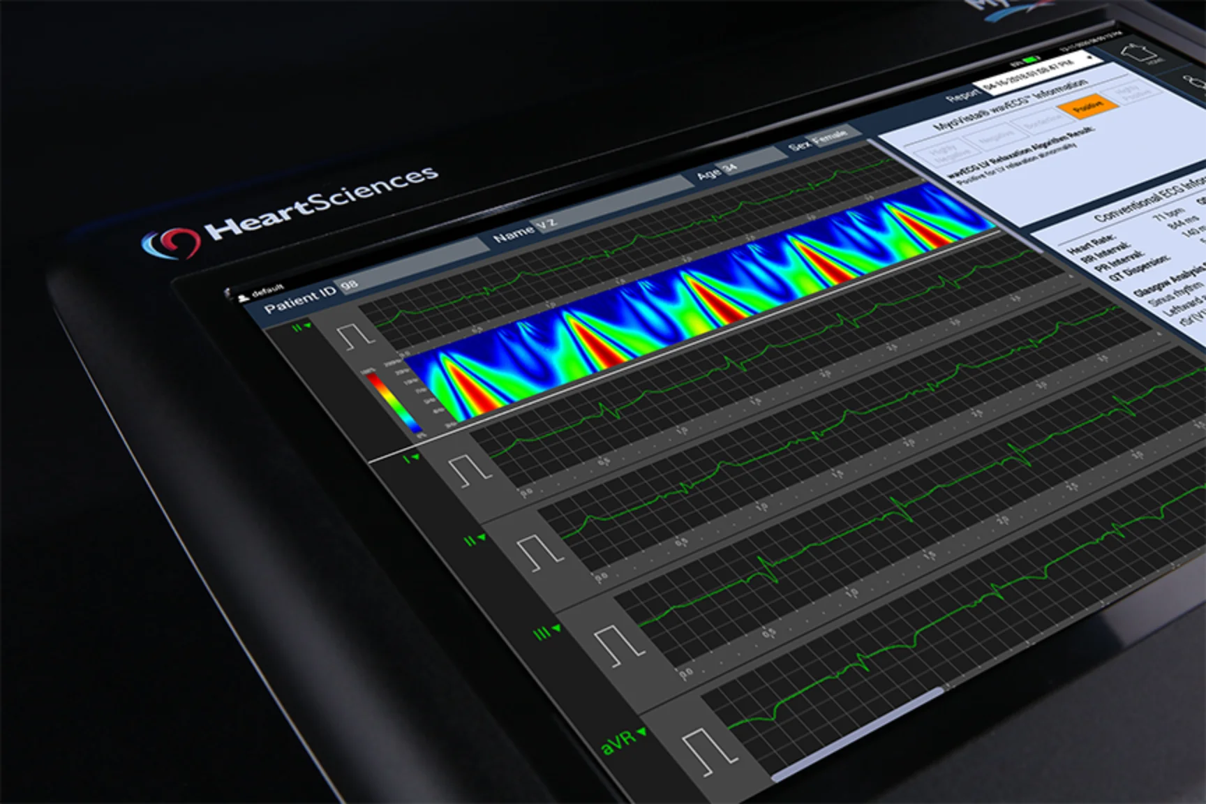 MyoVista wavECG Device - AI-Optimized ECG Acquisition