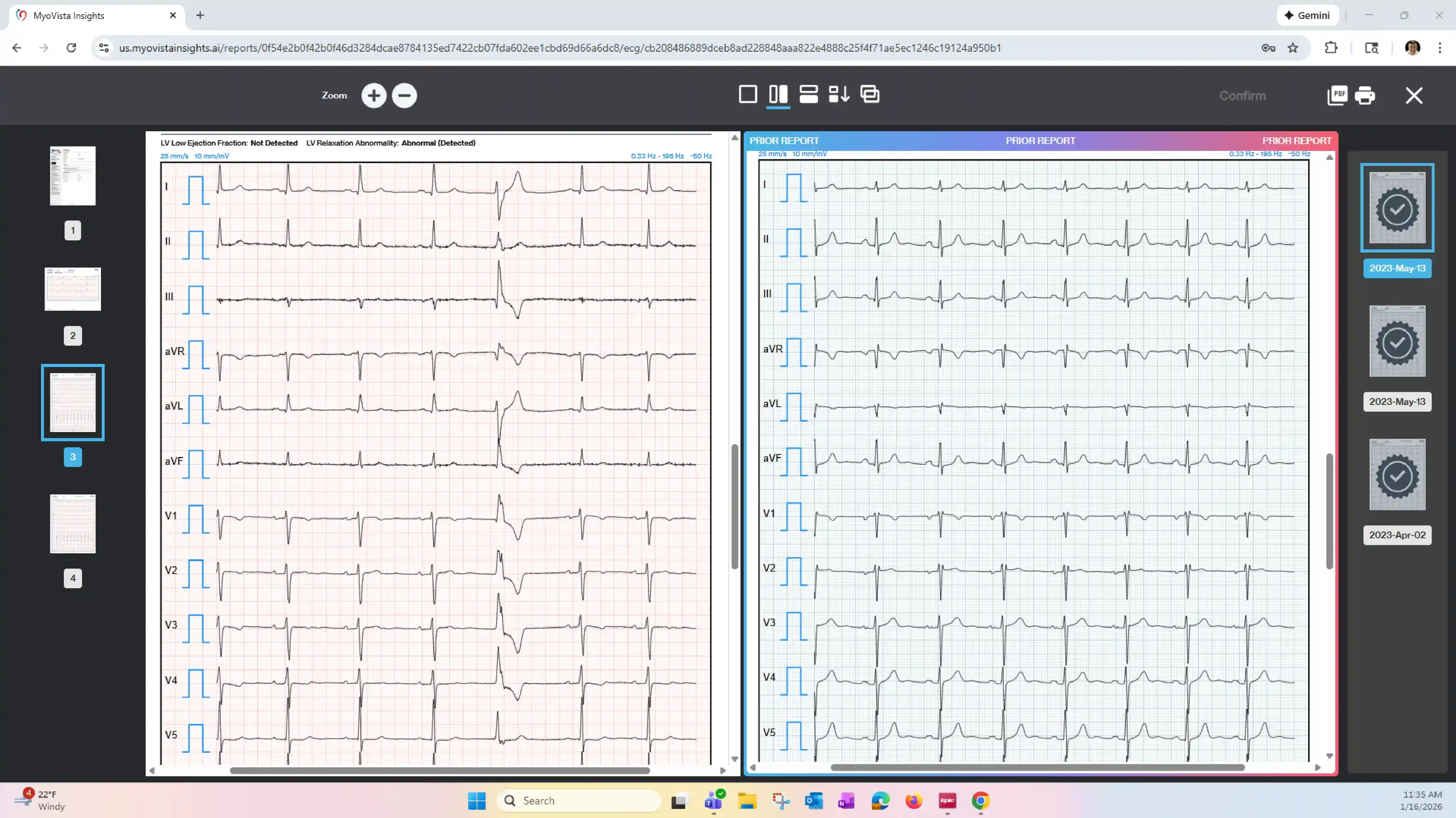 MyoVista Insights - AI-Powered ECG Analysis Dashboard