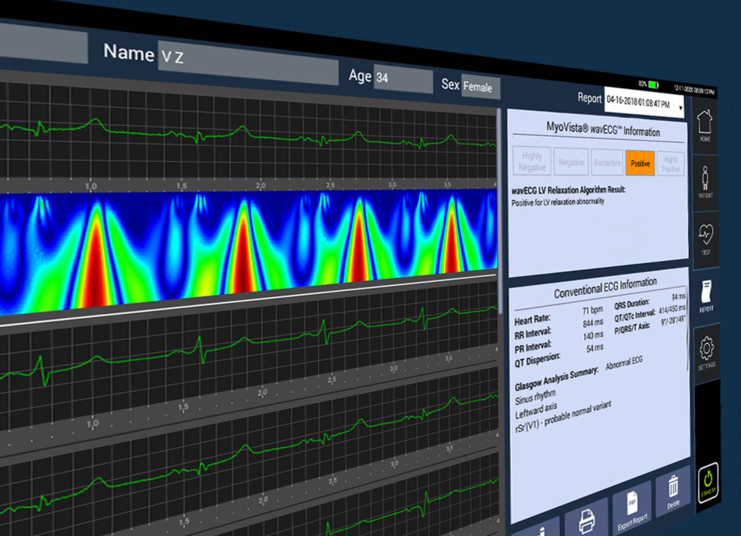MyoVista Insights - High-Fidelity ECG Signal Analysis